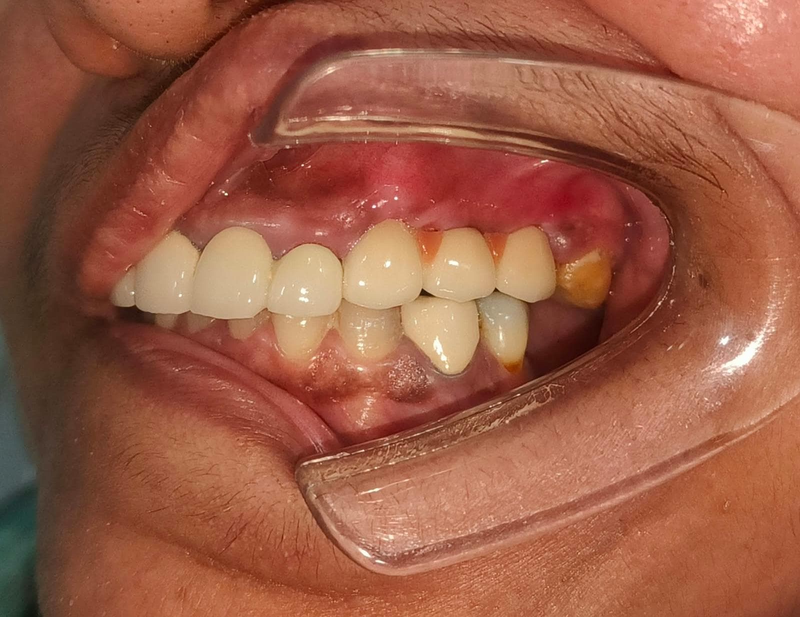 After Implant Restoration treatment