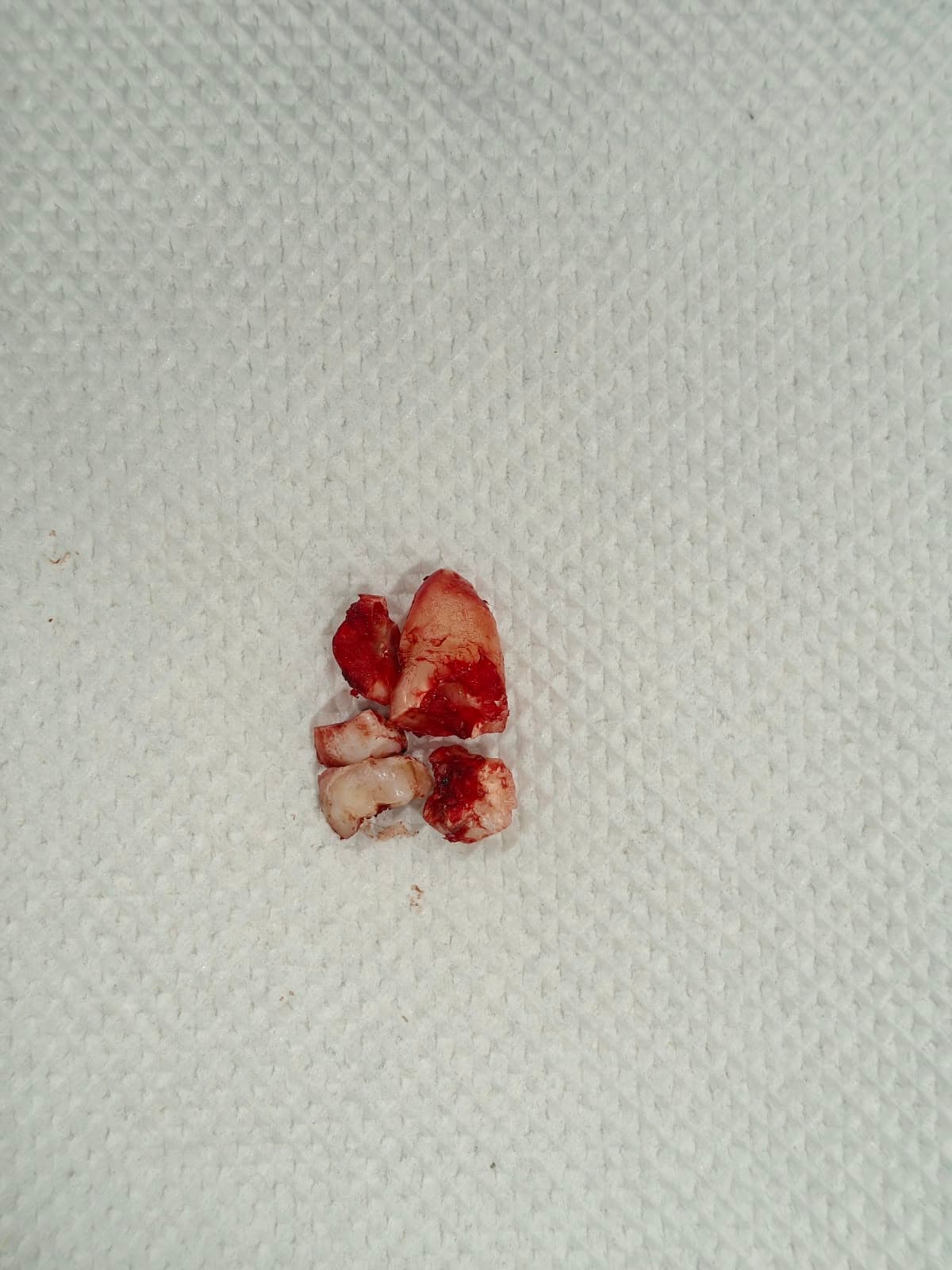 After Wisdom Tooth Extraction treatment