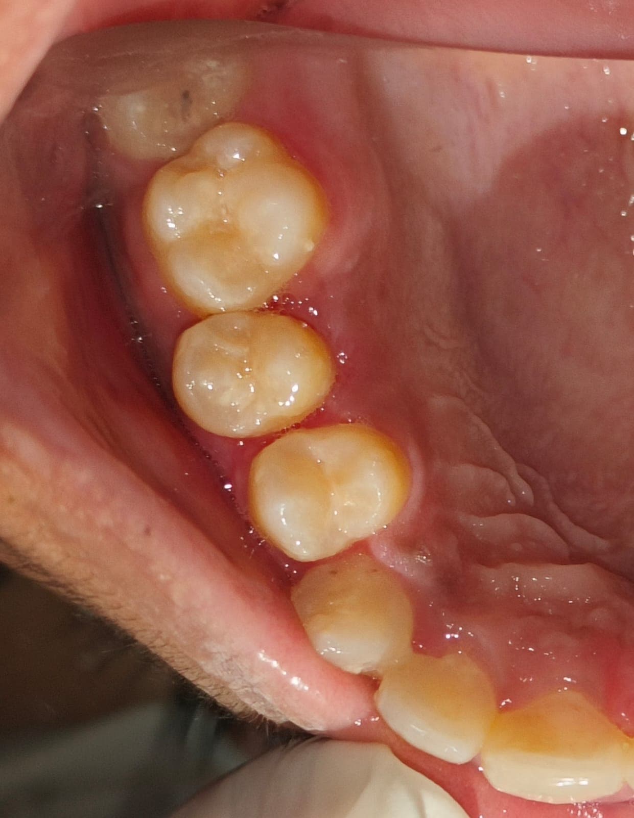 After Gum Treatment treatment