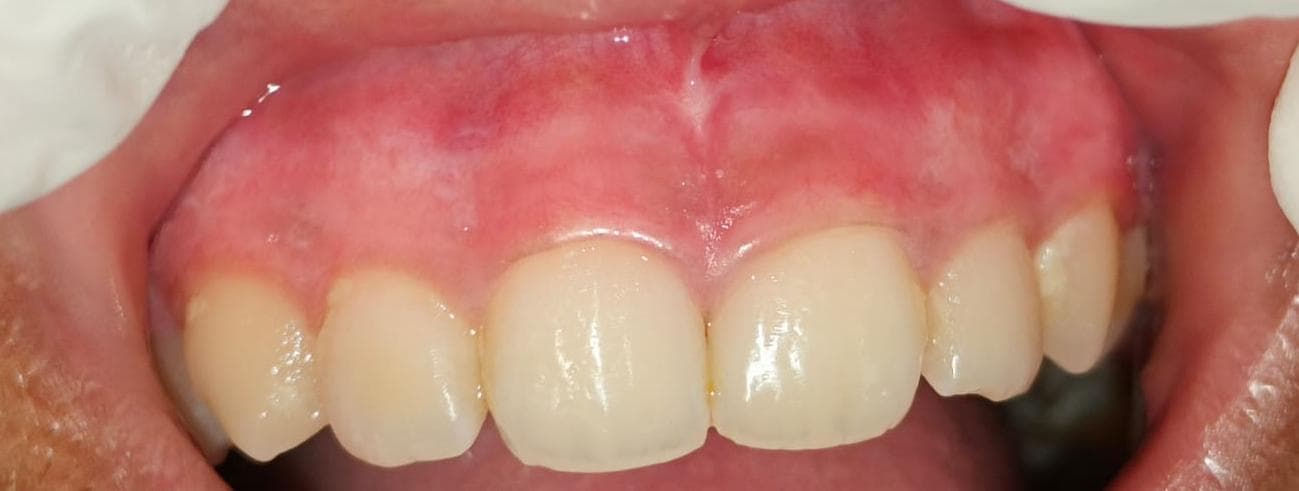 After Aesthetic Depigmentation Procedure treatment