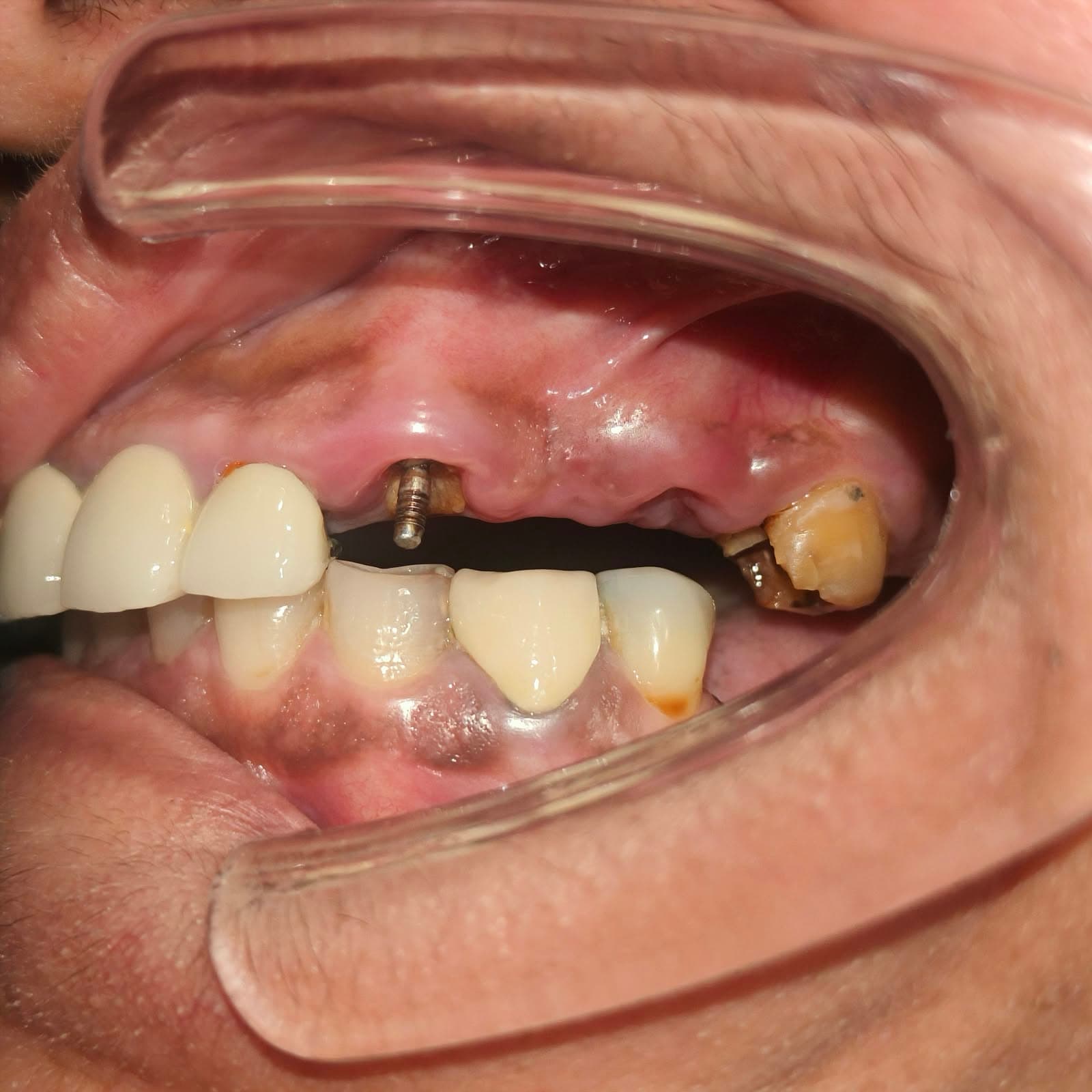 Before Implant Restoration treatment
