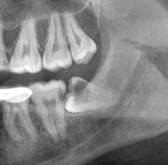 Before Wisdom Tooth Extraction treatment