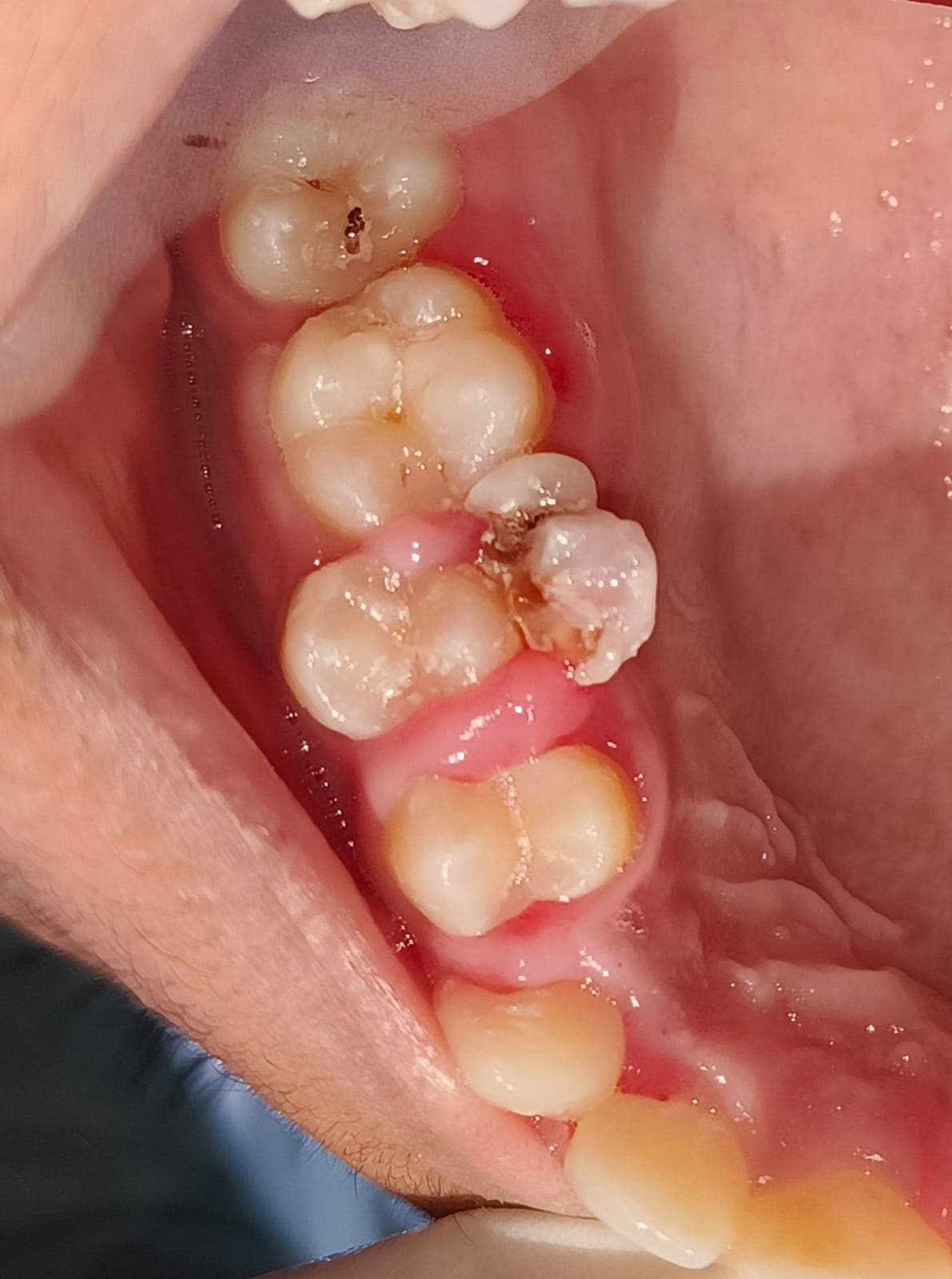 Before Gum Treatment treatment