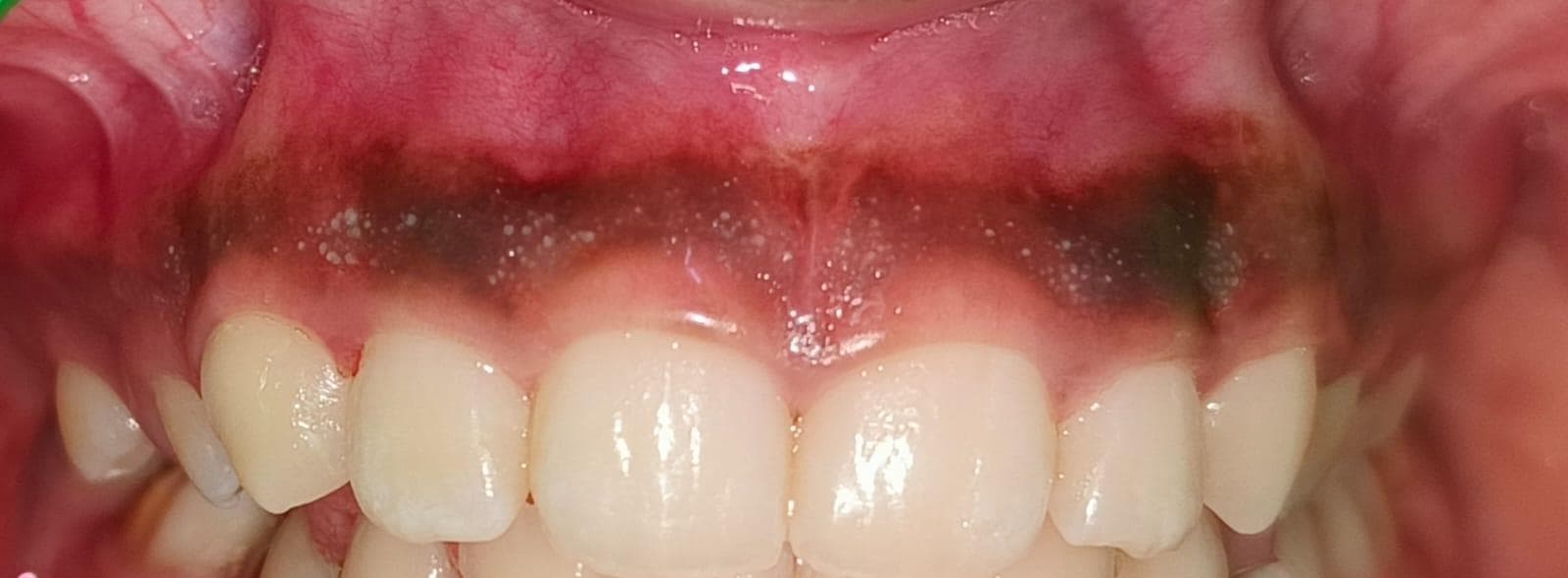 Before Aesthetic Depigmentation Procedure treatment